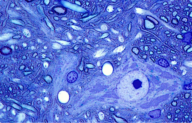 Alzheimer's disease psychosis